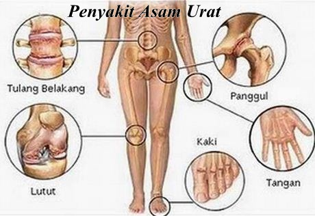 penyakit-asam-urat.jpg